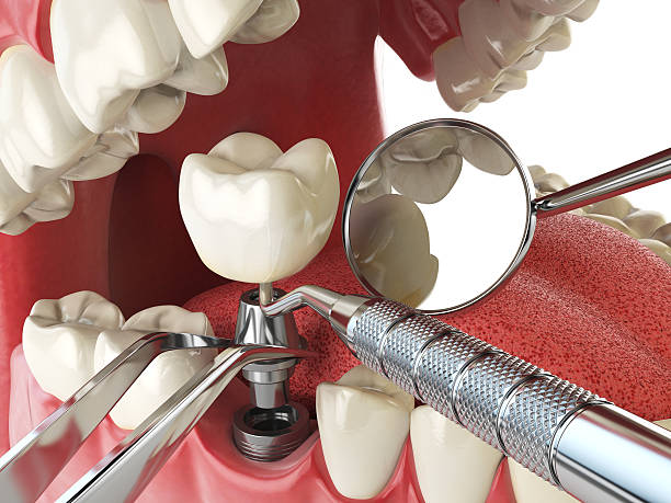 Best Emergency Wisdom Tooth Extraction in , DC
